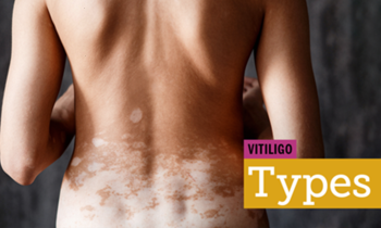  Λεύκη που προκαλείται από φάρμακα