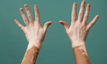 Πως σταματάει η Λεύκη