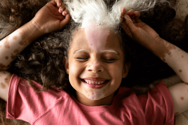 vitiligo kids