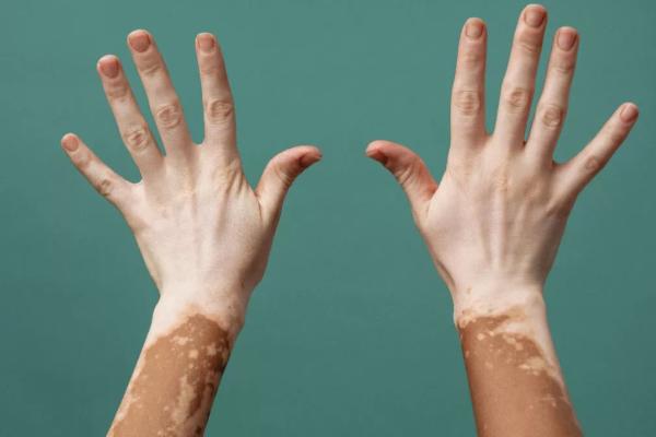 Πως σταματάει η Λεύκη